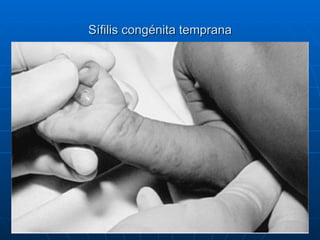 Sífilis congénita temprana 