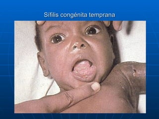 Sífilis congénita temprana 