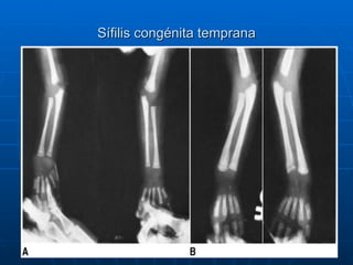 Sífilis congénita temprana 