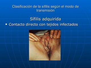 Clasificación de la sífilis según el modo de transmisión Sífilis adquirida Contacto directo con tejidos infectados 