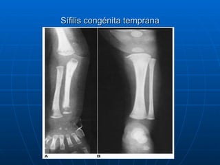 Sífilis congénita temprana 