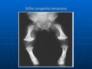 Sífilis congénita temprana 