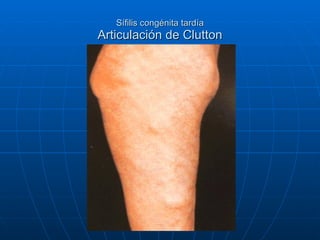 Sífilis congénita tardía Articulación de Clutton 