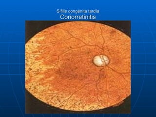 Sífilis congénita tardía Coriorretinitis 