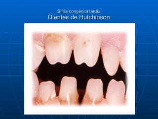 Sífilis congénita tardía Dientes de Hutchinson 
