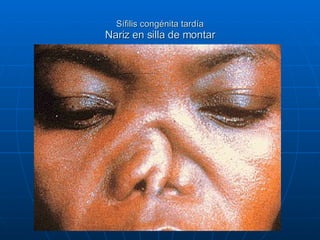 Sífilis congénita tardía Nariz en silla de montar 
