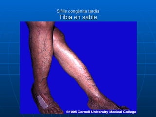 Sífilis congénita tardía Tibia en sable 