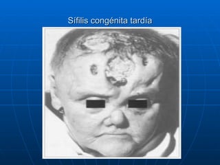 Sífilis congénita tardía 