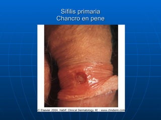 Sífilis primaria Chancro en pene 