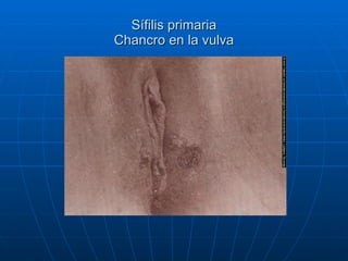 Sífilis primaria Chancro en la vulva 