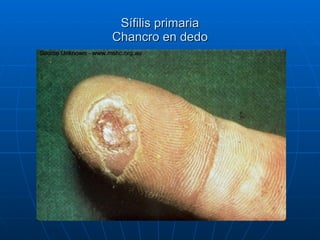 Sífilis primaria Chancro en dedo 