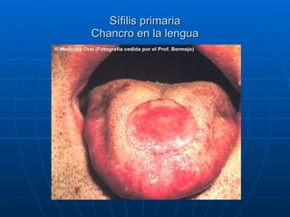 Sífilis primaria Chancro en la lengua 