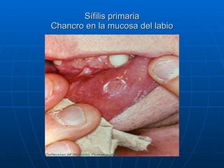 Sífilis primaria Chancro en la mucosa del labio 