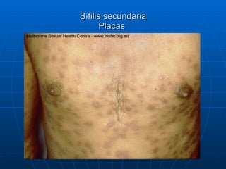 Sífilis secundaria Placas  