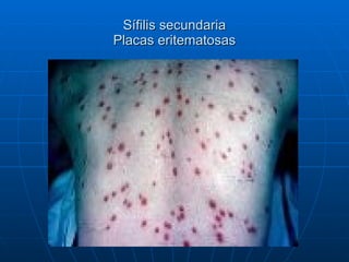 Sífilis secundaria Placas eritematosas 