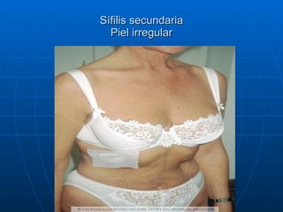 Sífilis secundaria Piel irregular 