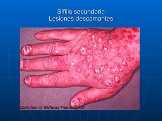 Sífilis secundaria Lesiones descamantes 