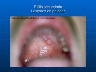Sífilis secundaria Lesiones en paladar 