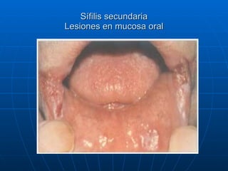 Sífilis secundaria Lesiones en mucosa oral 