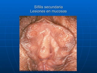Sífilis secundaria Lesiones en mucosas 