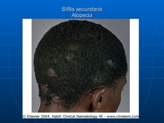 Sífilis secundaria Alopecia 