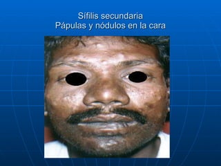 Sífilis secundaria Pápulas y nódulos en la cara 