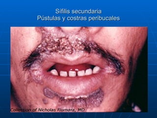 Sífilis secundaria Pústulas y costras peribucales 