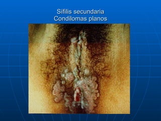Sífilis secundaria Condilomas planos 