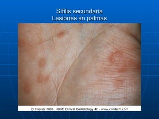 Sífilis secundaria Lesiones en palmas 