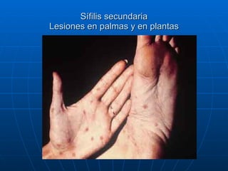 Sífilis secundaria Lesiones en palmas y en plantas 