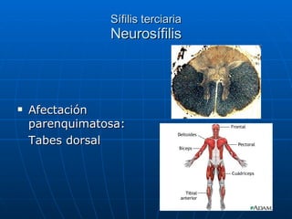 Sífilis terciaria Neurosífilis Afectación parenquimatosa: Tabes dorsal 
