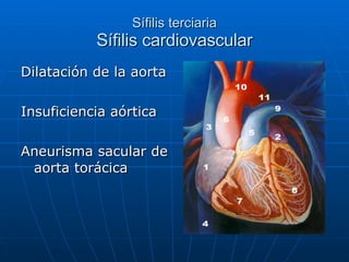 Sífilis terciaria Sífilis cardiovascular Dilatación de la aorta Insuficiencia aórtica Aneurisma sacular de aorta torácica 