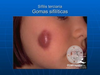 Sífilis terciaria Gomas sifilíticas 