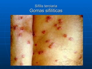 Sífilis terciaria Gomas sifilíticas 