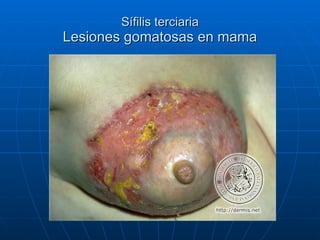 Sífilis terciaria Lesiones gomatosas en mama 