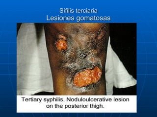 Sífilis terciaria Lesiones gomatosas 