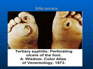 Sífilis terciaria 