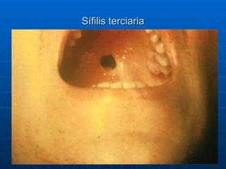 Sífilis terciaria 