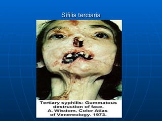 Sífilis terciaria 