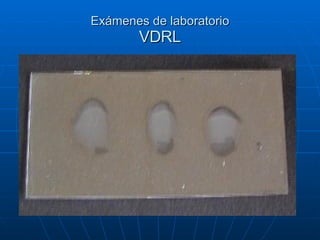 Exámenes de laboratorio VDRL 