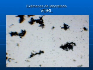 Exámenes de laboratorio VDRL 