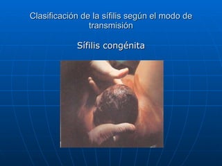 Clasificación de la sífilis según el modo de transmisión Sífilis congénita 