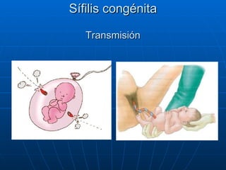 Sífilis congénita Transmisión 