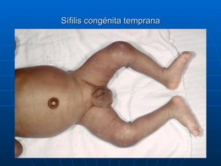 Sífilis congénita temprana 
