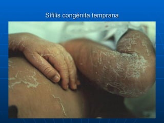 Sífilis congénita temprana 