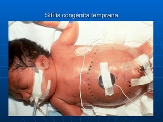 Sífilis congénita temprana 