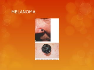 MELANOMA
 