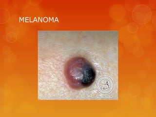 MELANOMA
 