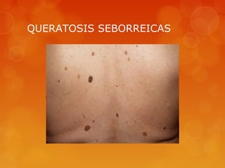 QUERATOSIS SEBORREICAS
 