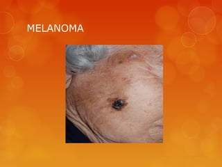 MELANOMA
 